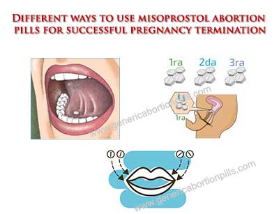 Misoprostol abortion pill